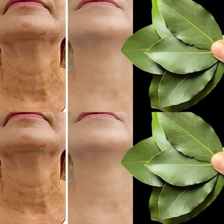 Liść laurowy jest 100 000 razy silniejszy niż botoks? | Naturalny środek na rozwiązanie nawet w wieku 70 lat!