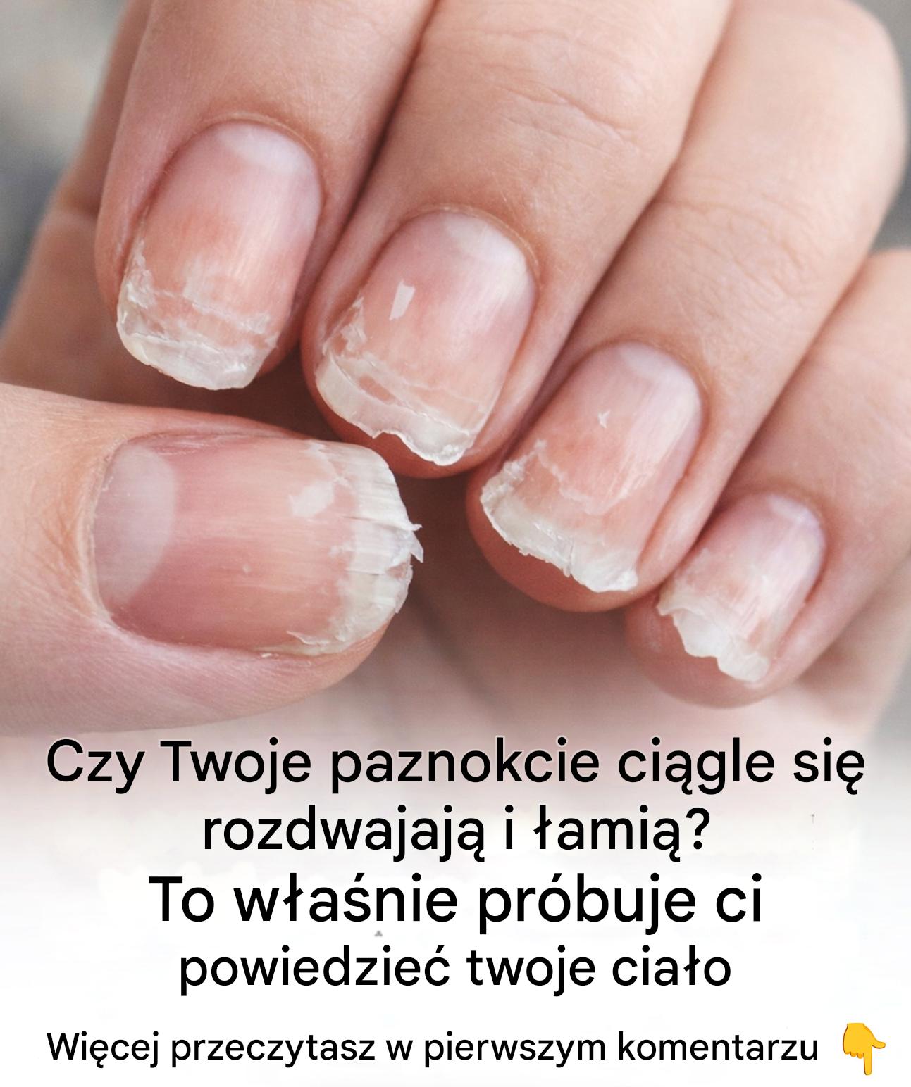 Łamliwe lub kruche paznokcie: co próbuje Ci powiedzieć Twoje ciało