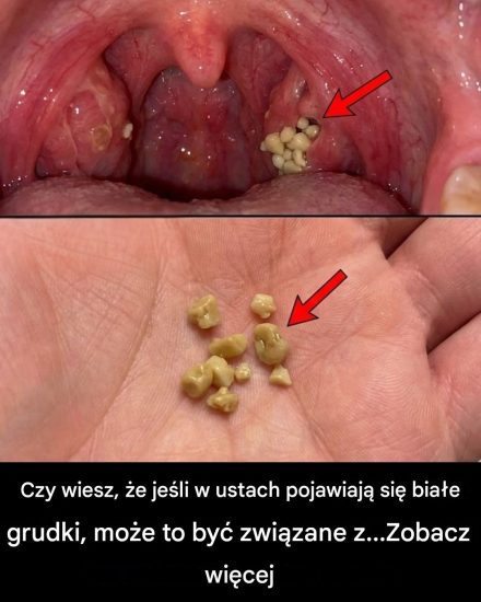 Kamienie migdałkowe: Dowiedz się, czym są, jak powstają i jak wypływają ich na zawsze.