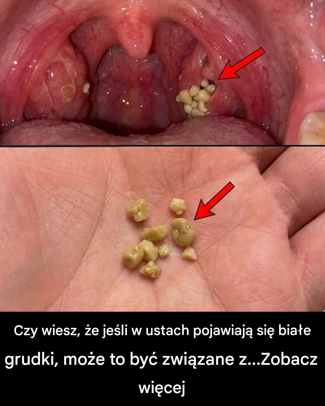 Kamienie migdałkowe: Dowiedz się, czym są, jak powstają i jak wypływają ich na zawsze.