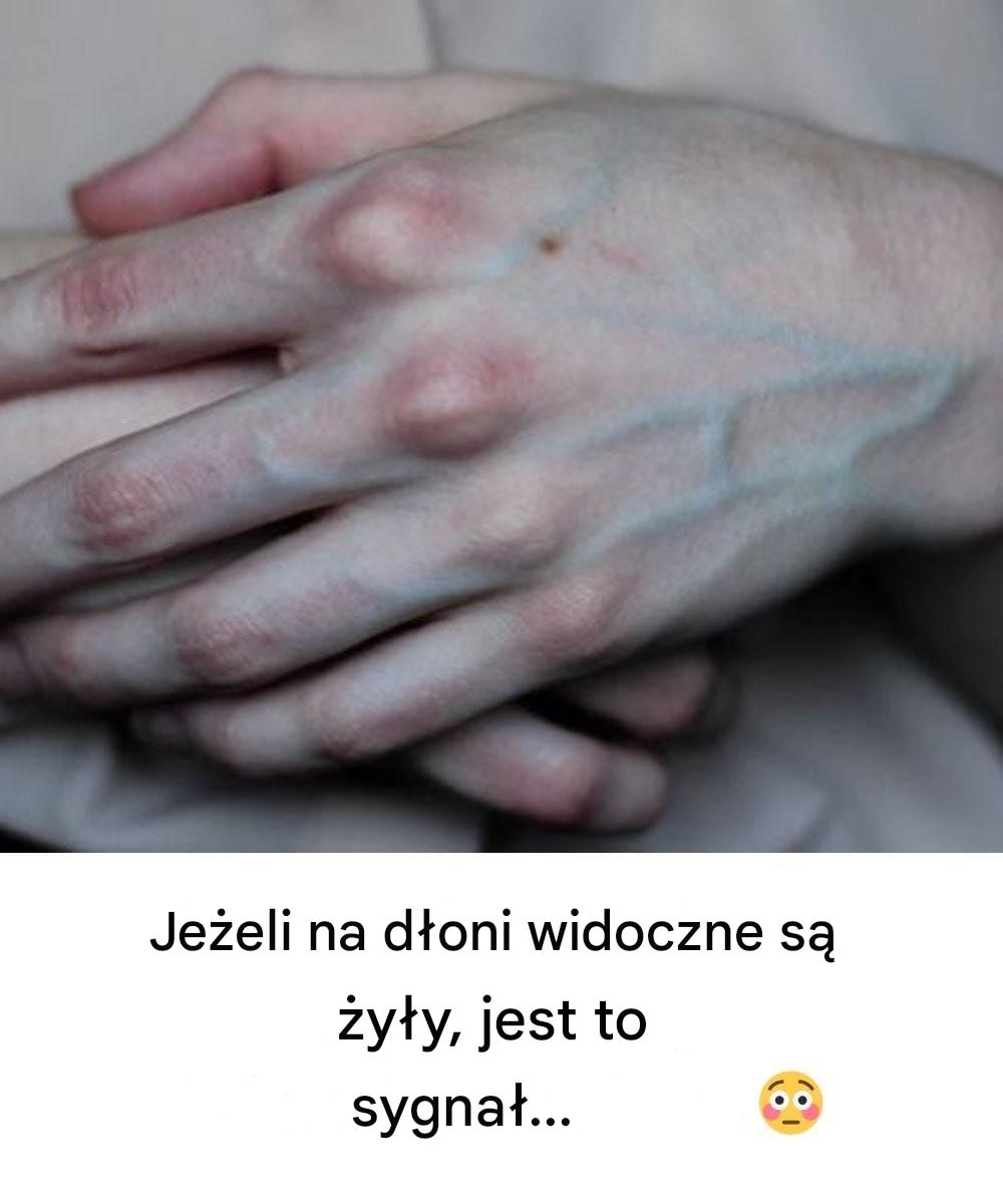 Co żyły na dłoniach mogą powiedzieć o zdrowiu wątroby