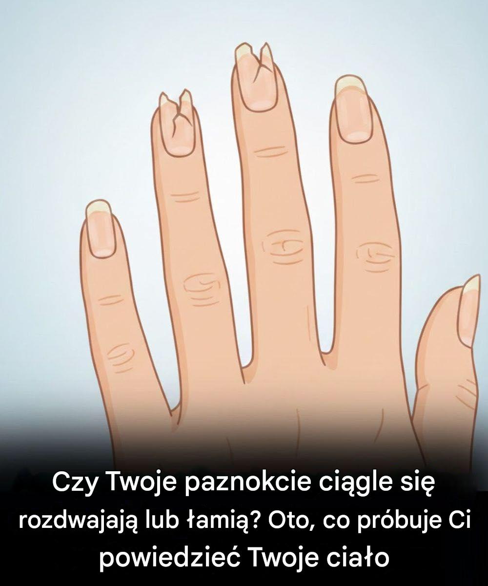 Jeśli Twoje paznokcie wyglądają tak, czas na wizytę kontrolną